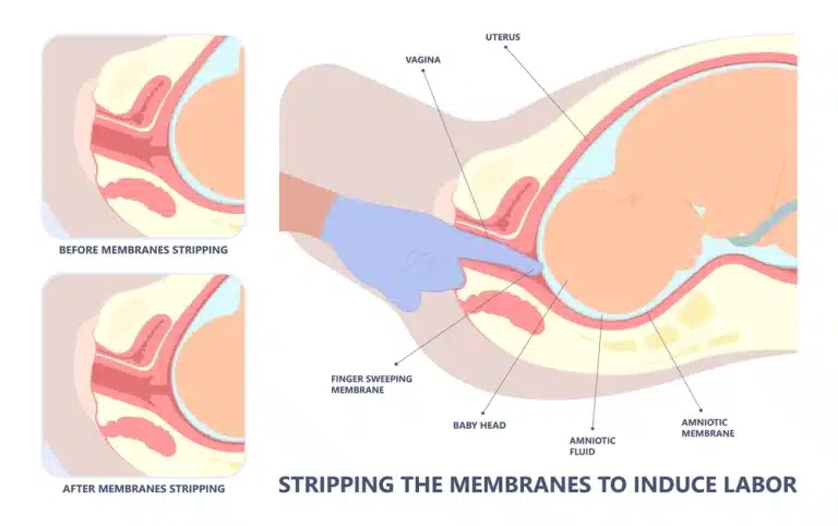 membrane Sweep